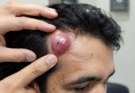 Simple Ways to Support Skin With Pimples and Blackheads