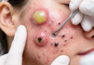 Practical Skin Care for Pimple and Blackhead Awareness